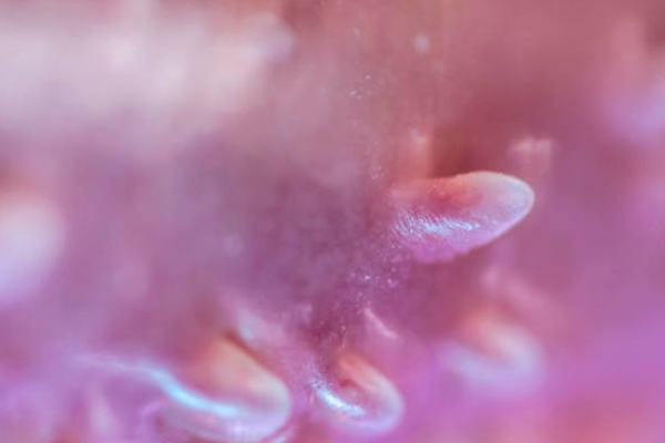 Qué síntomas indican que debo de acudir a la clínica de VPH